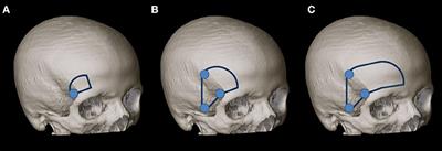 Interoptic, Trans-lamina Terminalis, Opticocarotid Triangle, and Caroticosylvian Windows From Mini-Supraorbital, Frontomedial, and Pterional Perspectives: A Comparative Cadaver Study With Artificial Lesions